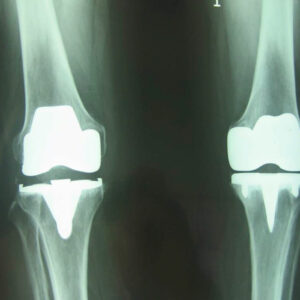 Protesis total de rodilla cementada con estabilizador posterior. Todos los componentes deben ser compatibles entre si. La seleccion del material y las medidas estara a cargo de las unidades de atencion de acuerdo a sus necesidades. Inserto de polietileno de ultra alta densidad moldeado con estabilizador posterior modular o total con espesor mínimo de 8 mm a 17.5 mm. Incluye medidas intermedias entre las especificadas. Tamaño: Extrachico chico mediano o grande. O su correspondiente en mm. Pieza.