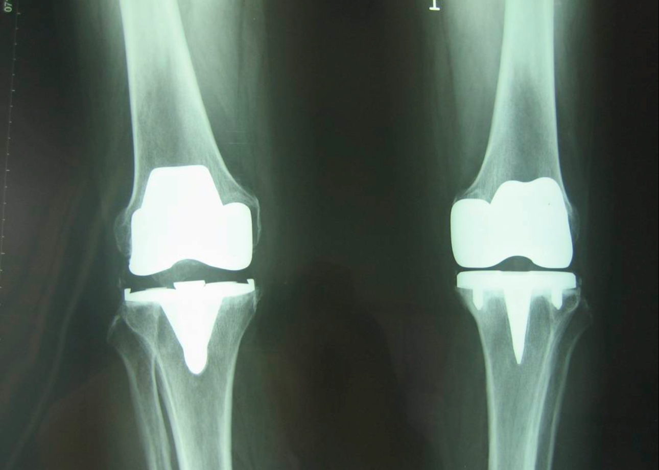 Protesis total de rodilla cementada con estabilizador posterior. Todos los componentes deben ser compatibles entre si. La seleccion del material y las medidas estara a cargo de las unidades de atencion de acuerdo a sus necesidades. Inserto de polietileno de ultra alta densidad moldeado con estabilizador posterior modular o total con espesor mínimo de 8 mm a 17.5 mm. Incluye medidas intermedias entre las especificadas. Tamaño: Extrachico chico mediano o grande. O su correspondiente en mm. Pieza.